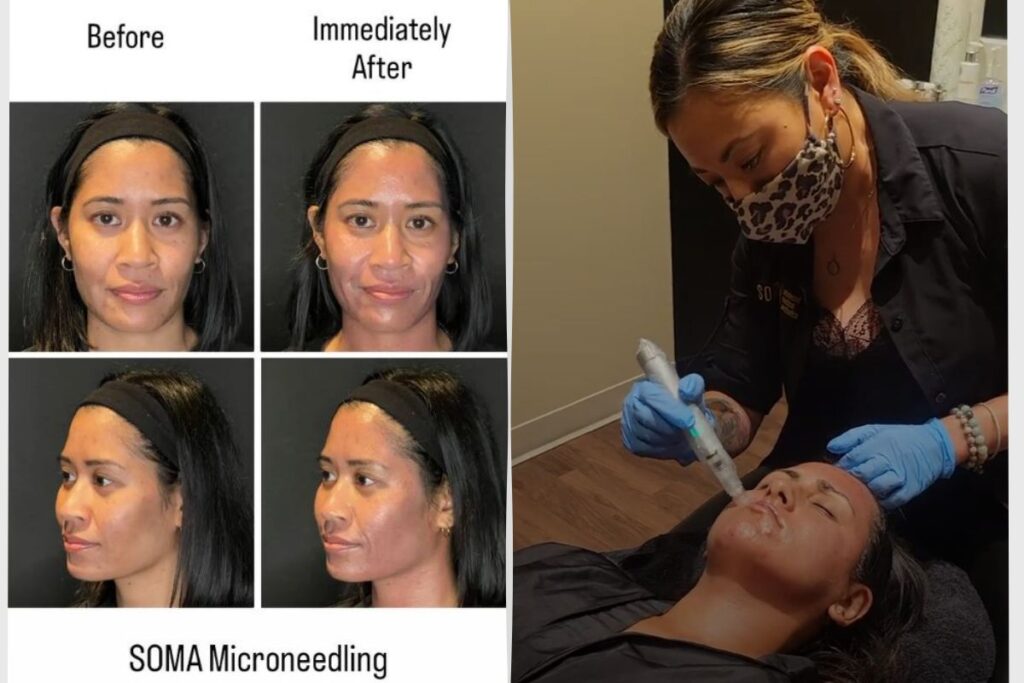 Microneedling Before and After – SOMA MD (1) non-surgical facelifts Dr. Monica Michel SOMA MD
