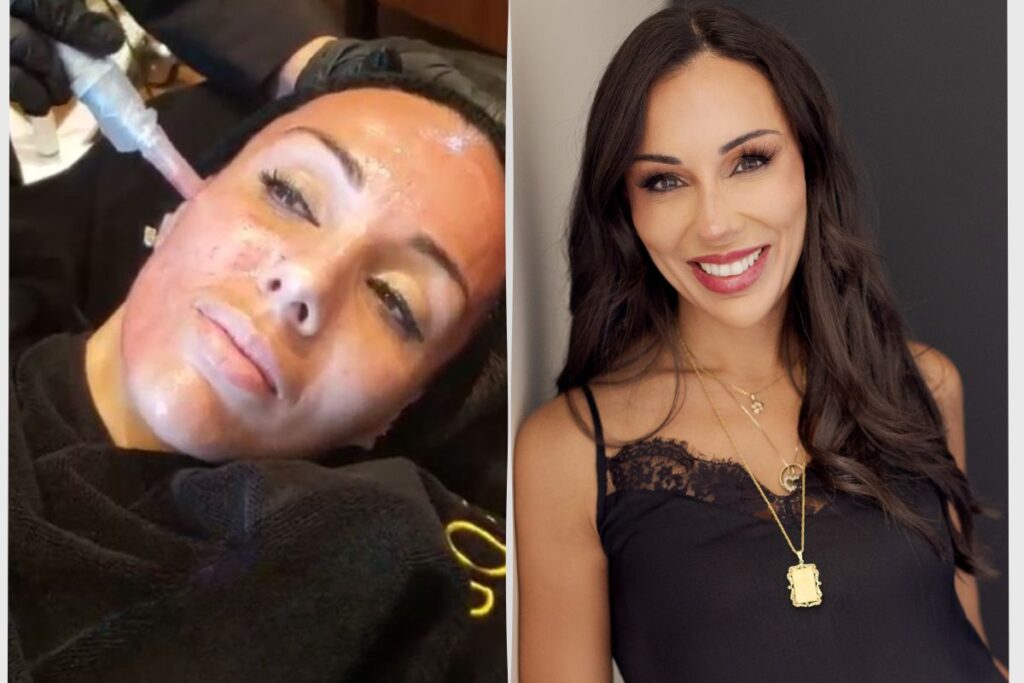 Microneedling Before and After – SOMA MD (2) non-surgical facelifts Dr. Monica Michel SOMA MD