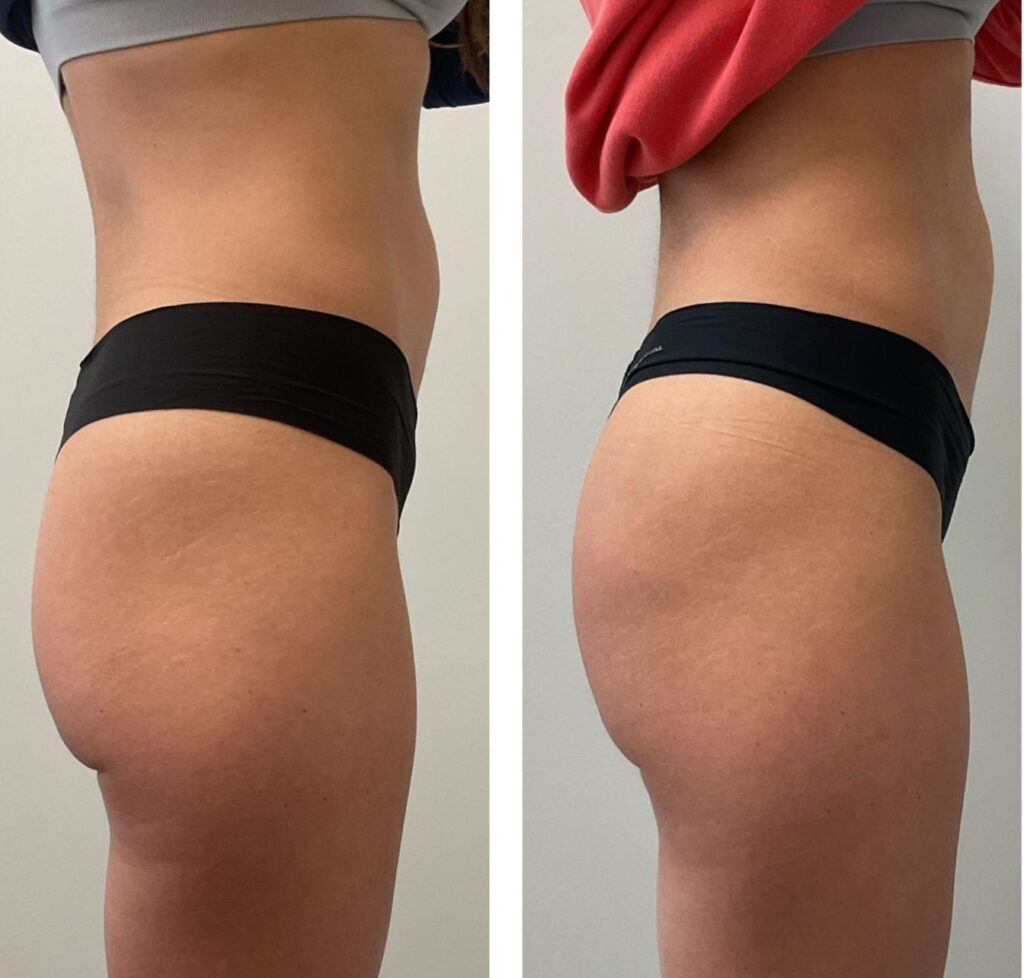 Liquid BBL with Revanesse ContourXL in South Surrey – SOMA MD (4) non-surgical facelifts Dr. Monica Michel SOMA MD